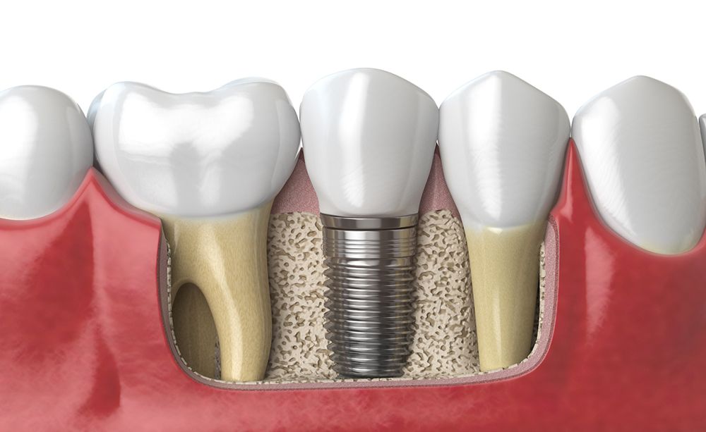 Dental Implants Center