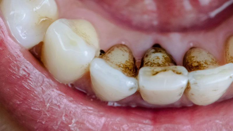 Black or brown Spot on a Teeth