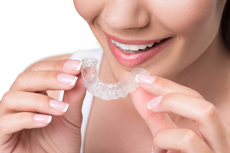 clear aligners