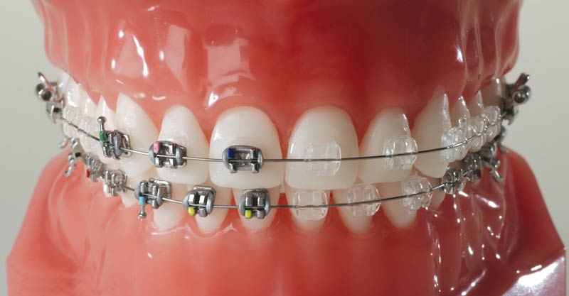 Clear Braces Vs. Metal Braces