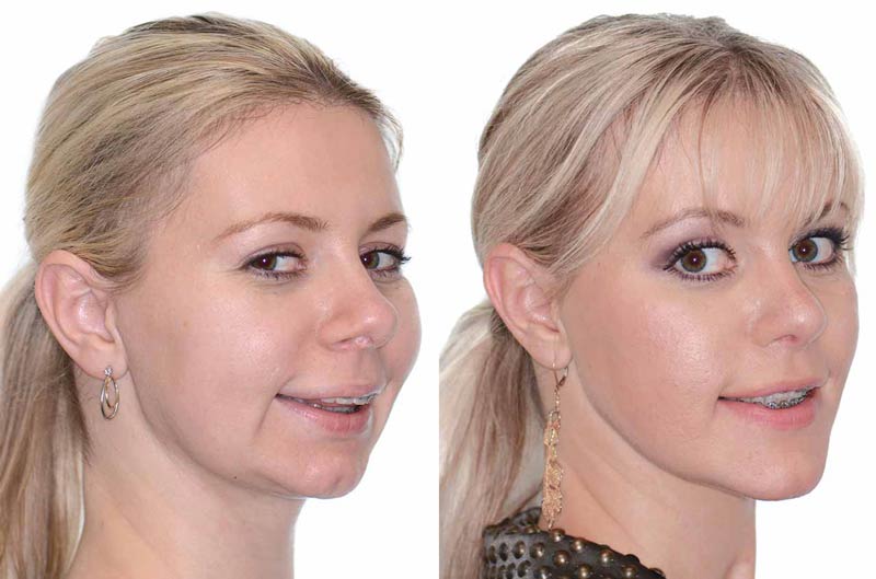 jaw surgery candidate