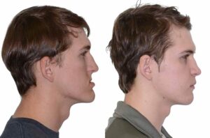 jaw surgery in Ancaster