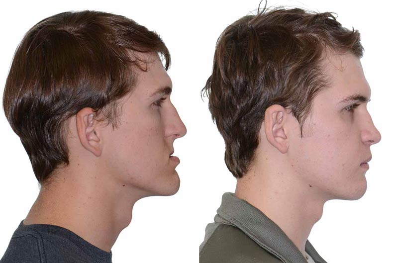 jaw surgery in Ancaster