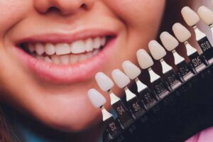 Teeth Bonding vs. Veneers