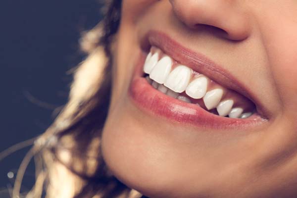 Teeth Bonding vs. Veneers