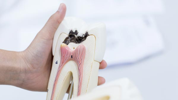 tooth decay
