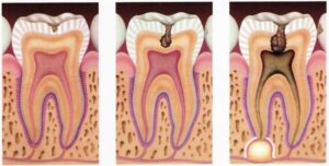 tooth decay