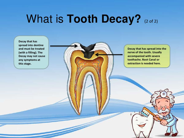 tooth decay
