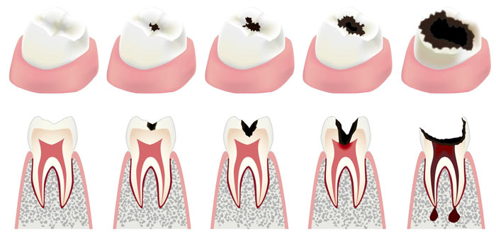 tooth decay