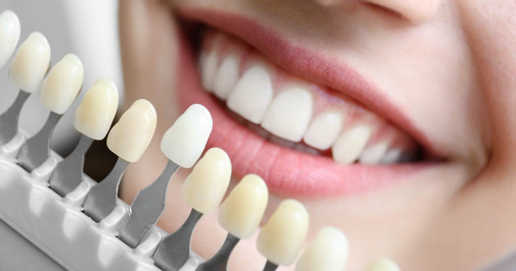 Composite Veneers
