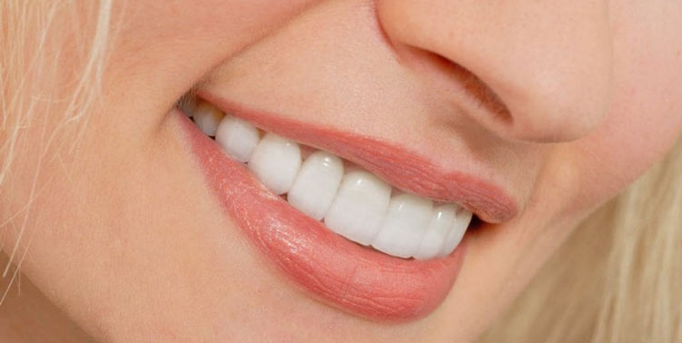 Lumineers Veneers