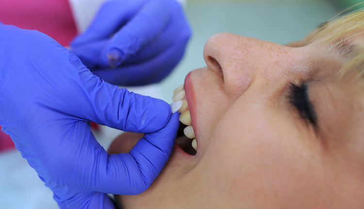 Palatal Veneers