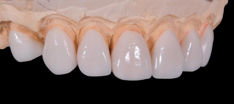 Porcelain-Fused-to-Metal Veneers