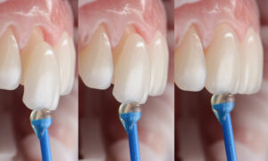 Porcelain Veneers