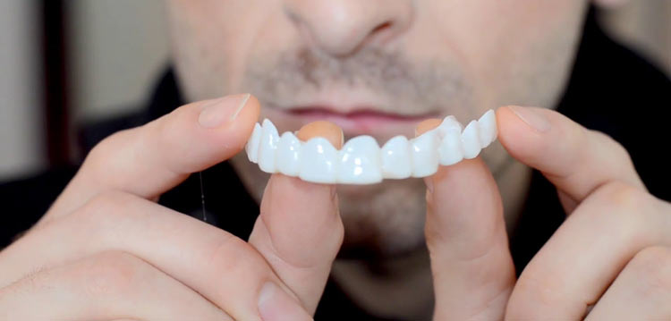 Removable Veneers