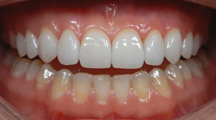 Resin Veneers