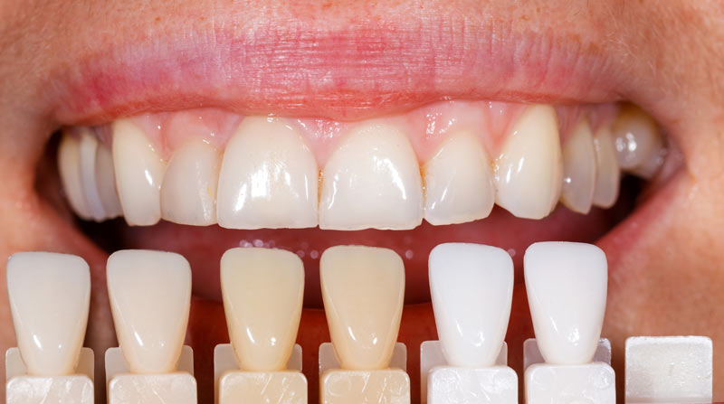 Types of Dental Veneers