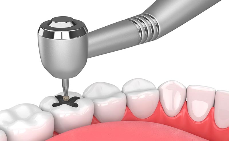 How Long Should a Dental Filling Last