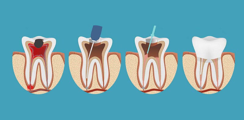 Most Common Signs You Need a Root Canal