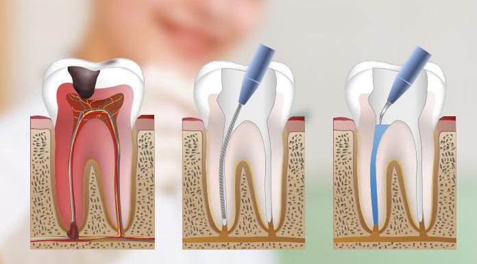 Most Common Signs You Need a Root Canal