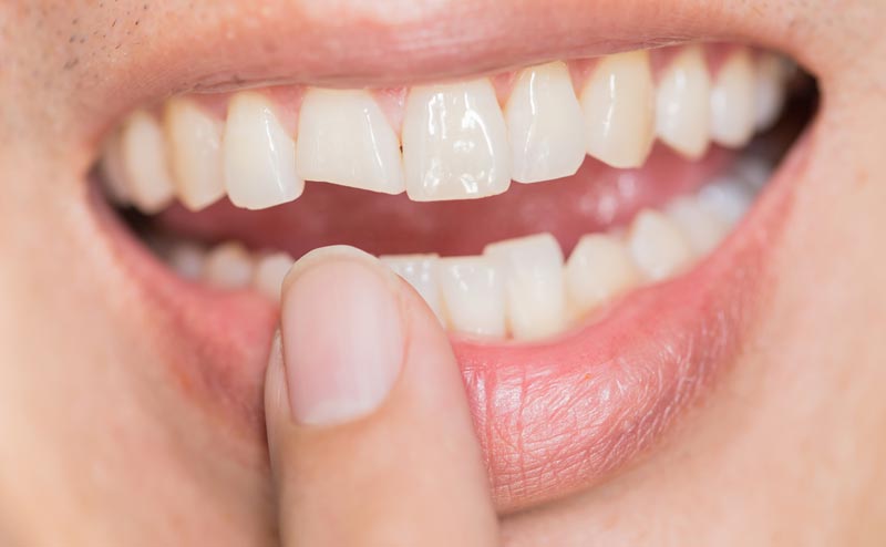 veneers for broken teeth