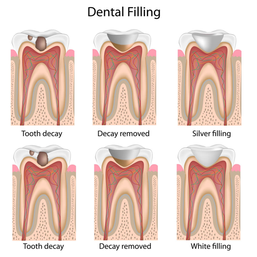 dental filling