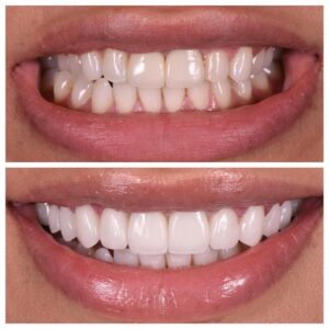 Various Types of Dental Veneers and Their Durability