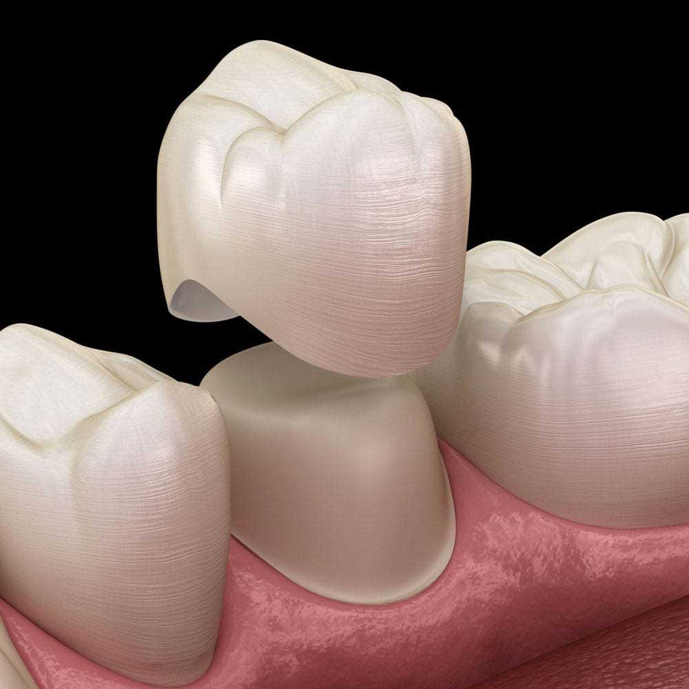 dental crowns