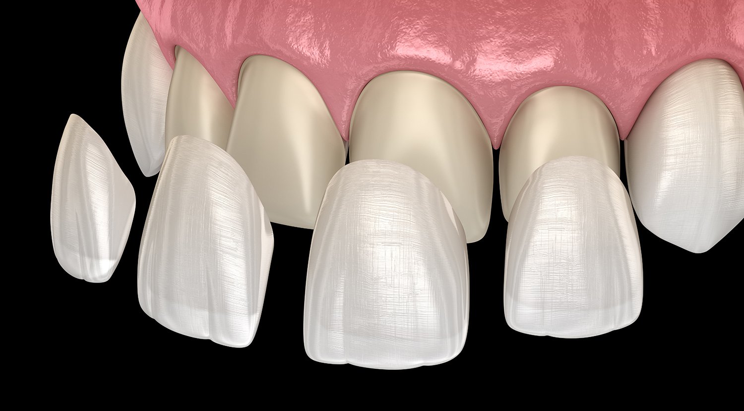composite veener