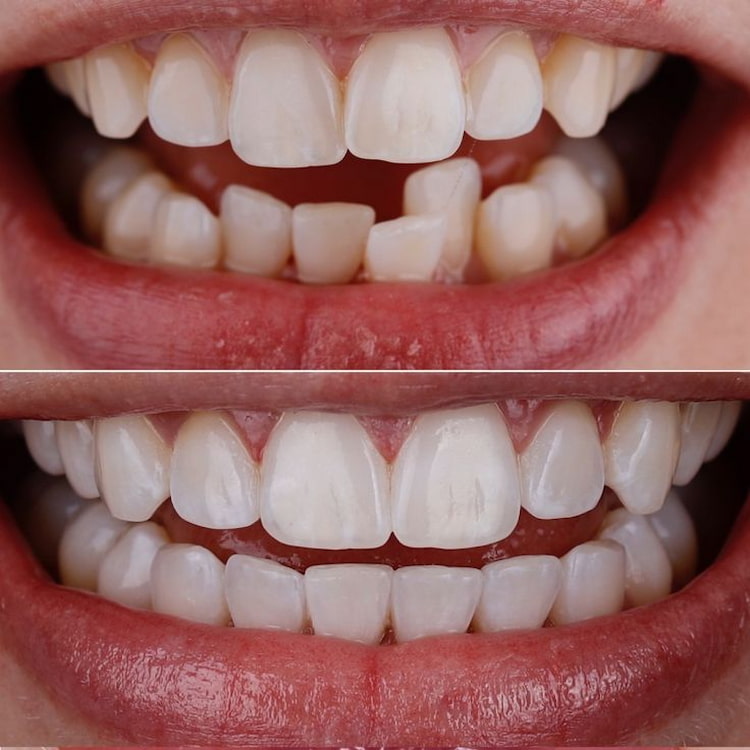 Invisalign vs. Braces