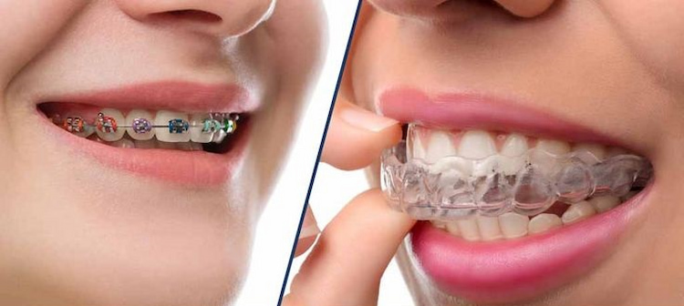Invisalign vs. Braces