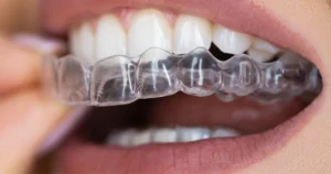 Step-by-Step Overview of the Invisalign Process