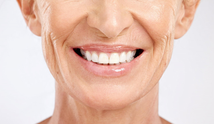 Veneers for Aging Teeth