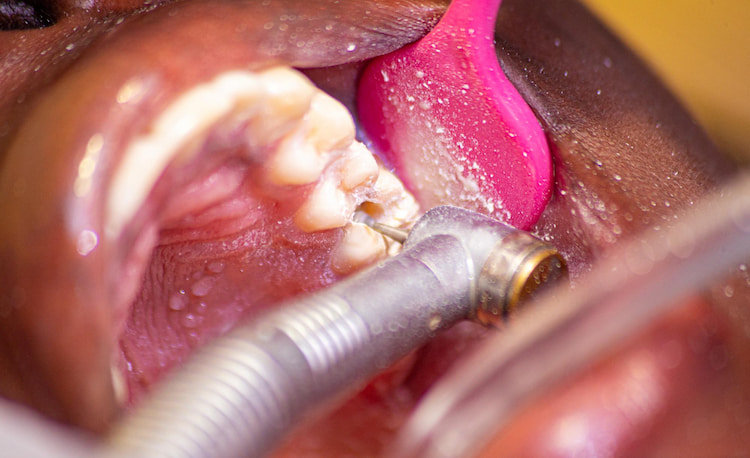 a dentist is drilling a tooth to peform a root canal therapy.