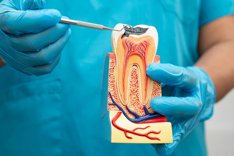 a dentist is holding a tooth model and showing how root canal treatment works.