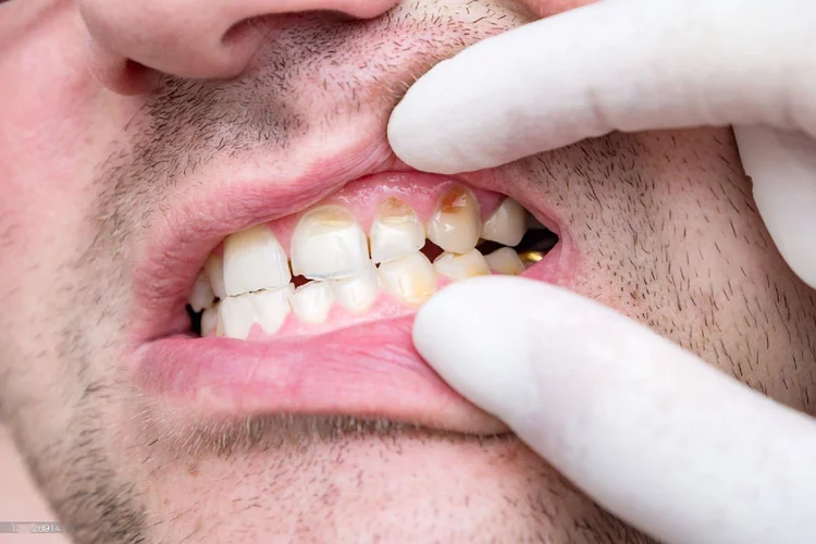 A picture of a man with cavity on his front tooth