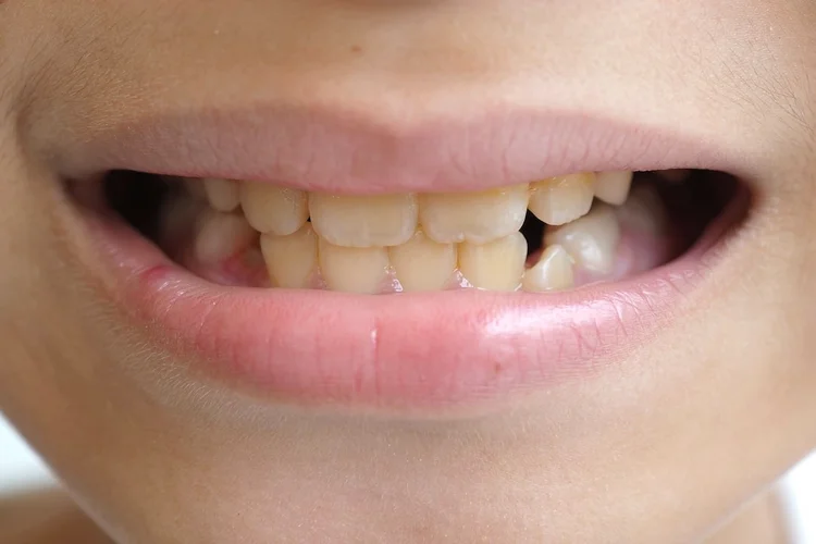 A picture of a child with a yellow set of teeth