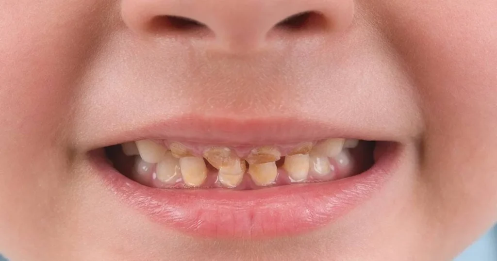 A picture of a child with yellow teeth