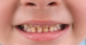 A picture of a child with yellow teeth