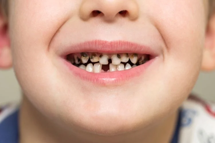 A picture of a child with cavity on his front teeth