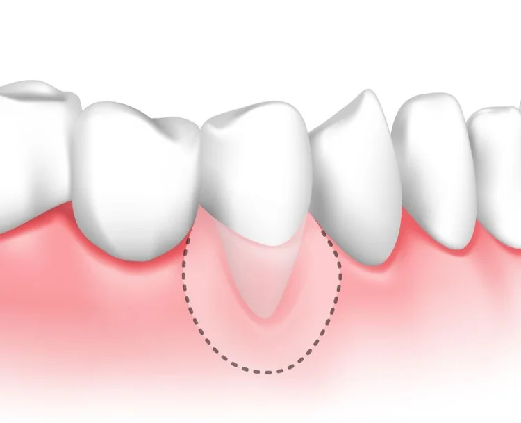A picture representing exposed tooth root