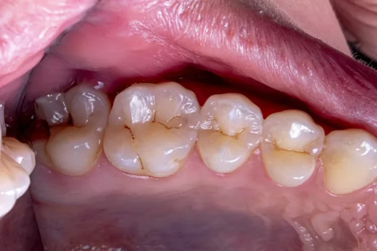 A picture of a exposed tooth root