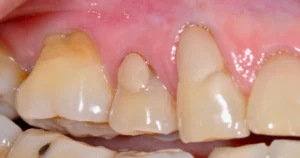 A picture of exposed tooth root