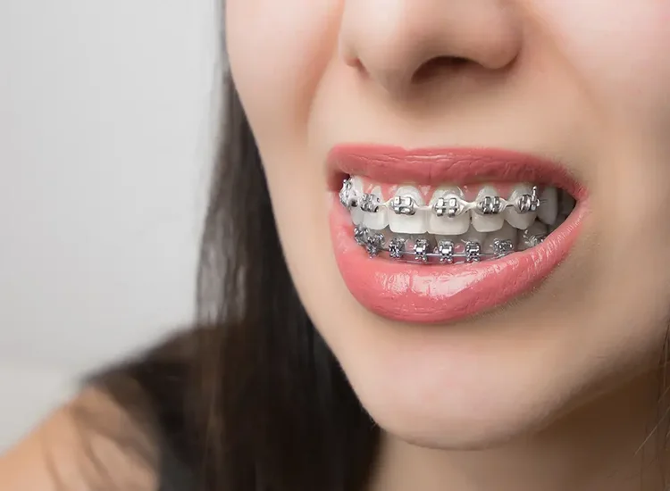 A picture of a lady with braces