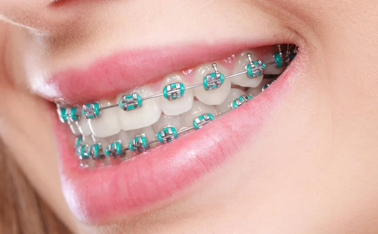 A picture of a lady with blue colored braces