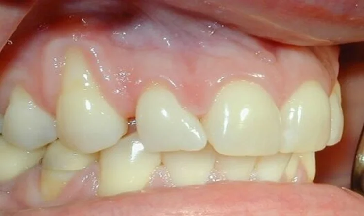 a tooth that has exposed root