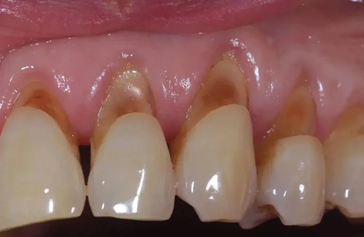 A set of teeth with exposed root