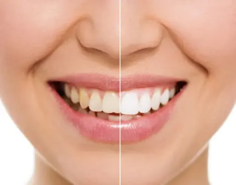 An before and after picture of teeth whitening