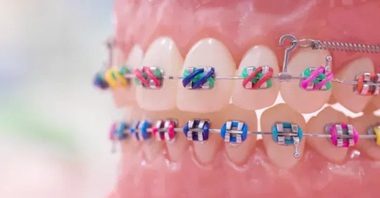 A picture of multi colour braces