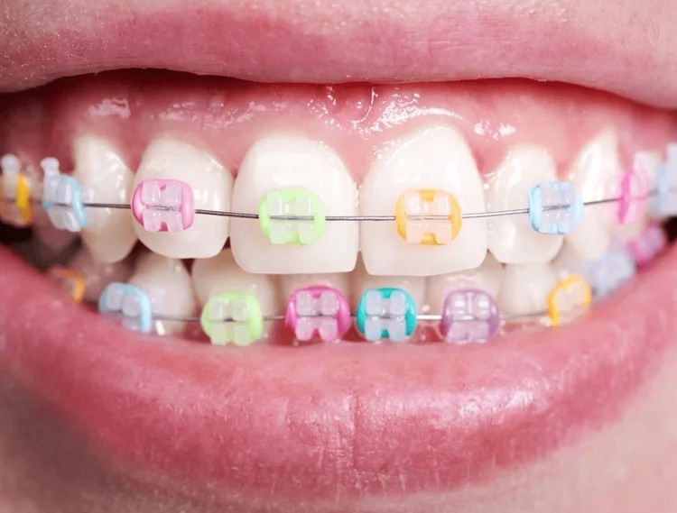 A picture representing colorful braces for children